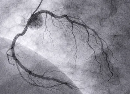 Pulmonary Artery Disorders