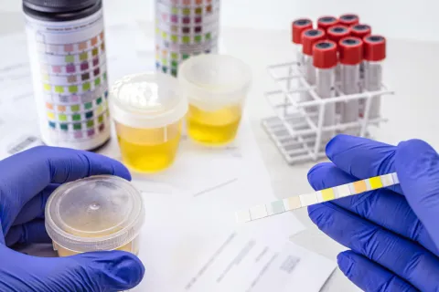 Microalbuminuria Predicts Future Type 2 Diabetes in UK Biobank