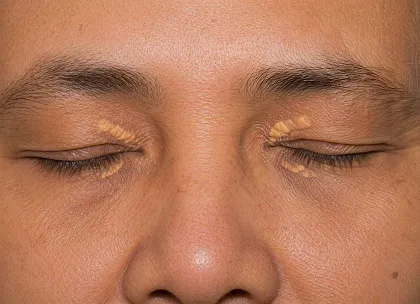 Xanthelasma
