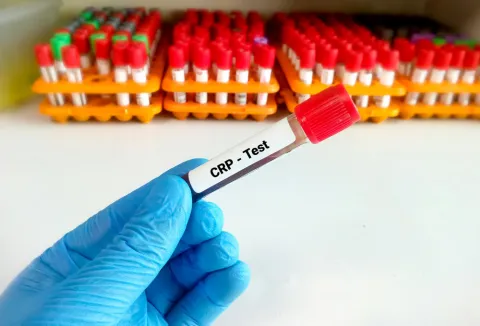 Does hs-CRP and Metabolic Syndrome Refine CAD Risk in T1DM? 