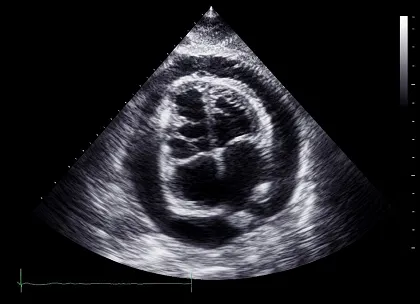Tamponade
