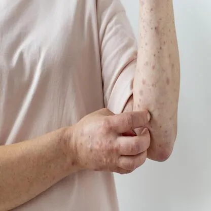  Erythema Multiforme 