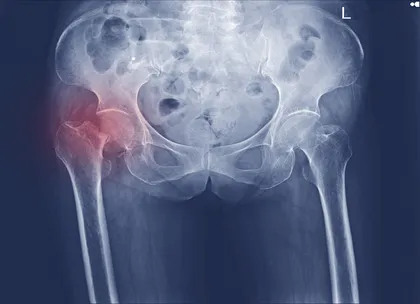 Femoral neck BMD