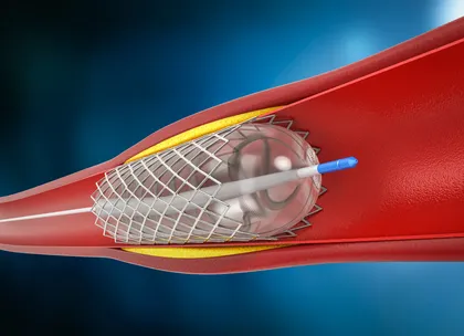 PCI