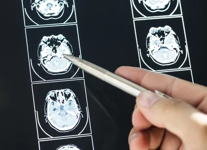 Brain MRI