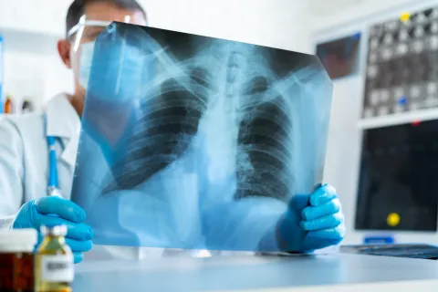 Lung Cancer