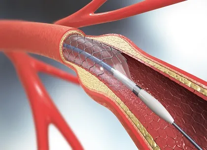 Stent