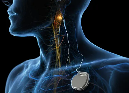 Vagal Nerve Stimulation
