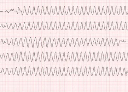 ventricular Arrhythmia