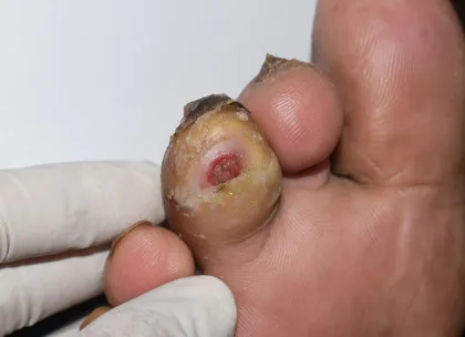 Diabetic foot