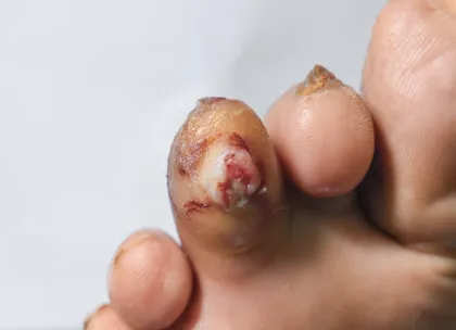 Diabetic foot