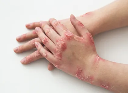 a patient suffering from psoriasis