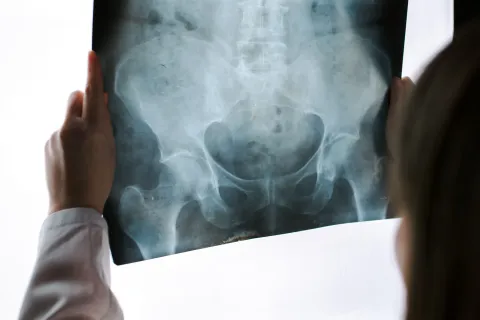 Hip Fracture 
