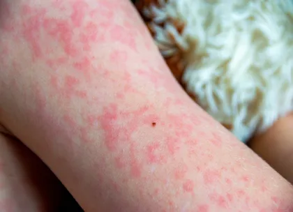 Rashes