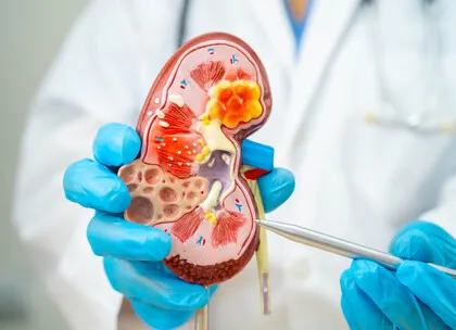 CKD
