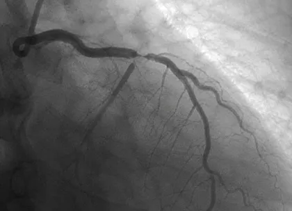 LAD Stenosis