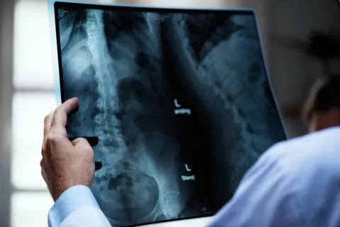 Low HALP Scores Were Linked to Higher Fracture Risk in T2DM