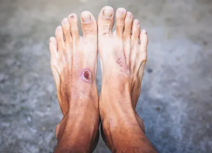 Diabetic foot